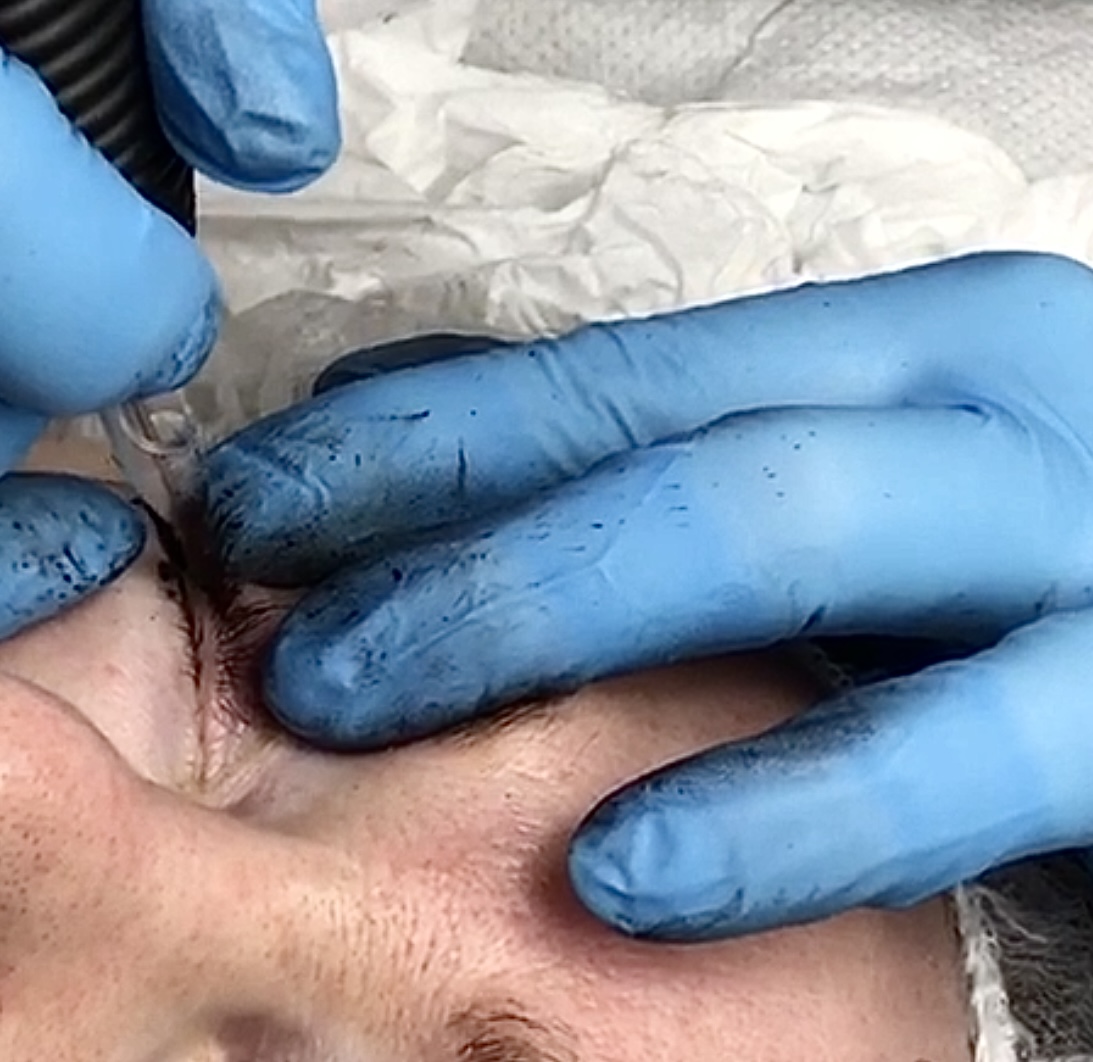 Eyelid Eyelid