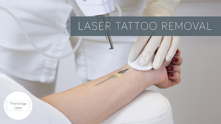 Laser Tattoo Removal