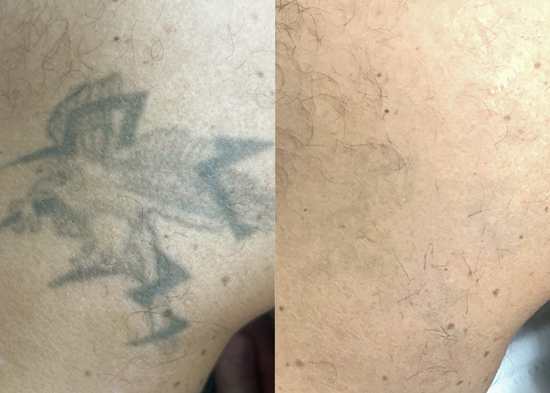 Tattoo Laser Removal Tattoo Laser Removal