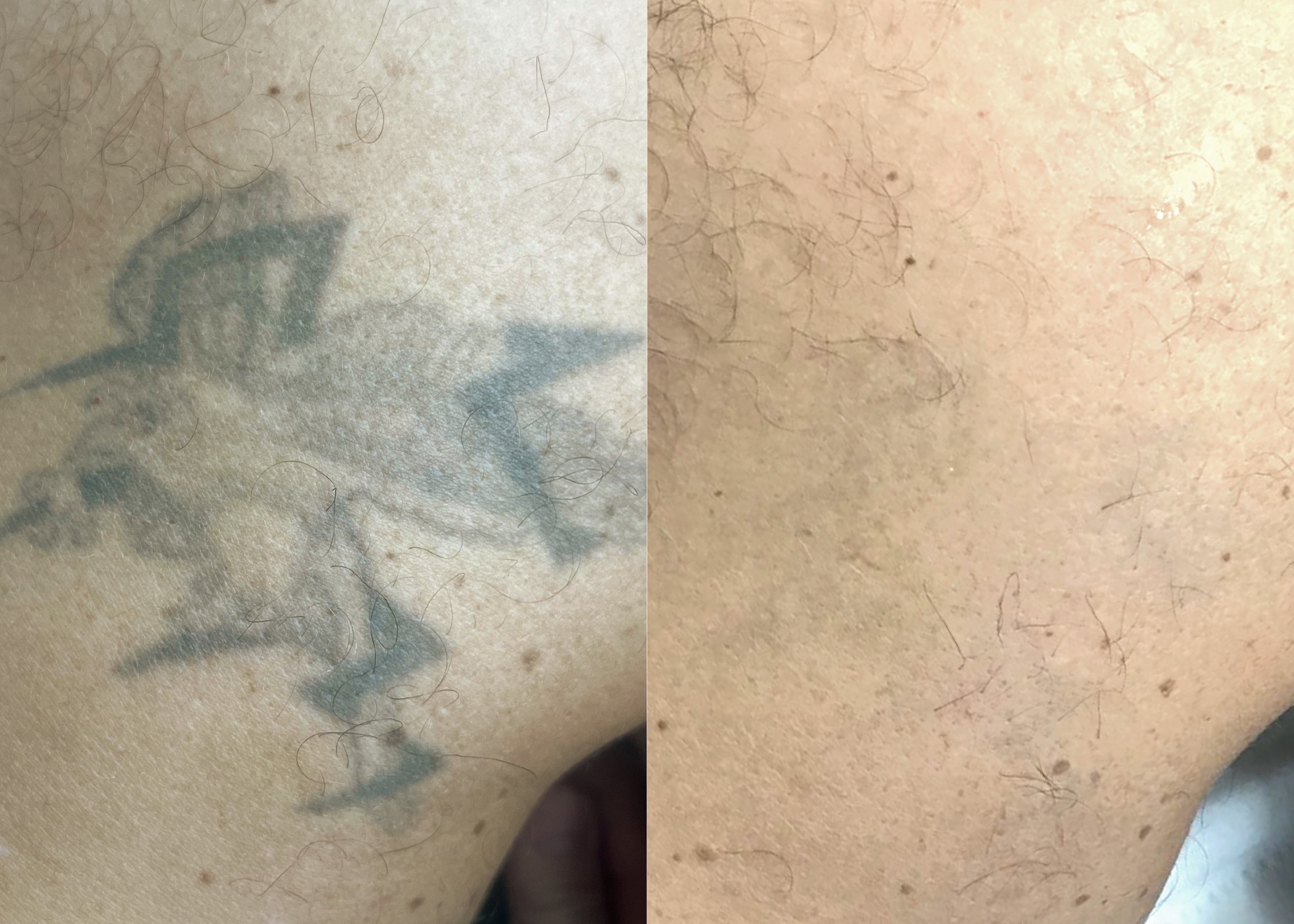 Tattoo Laser Removal