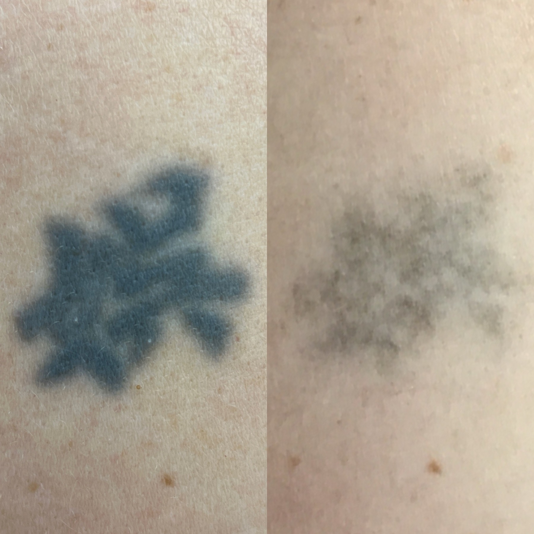 Tattoo Laser Removal