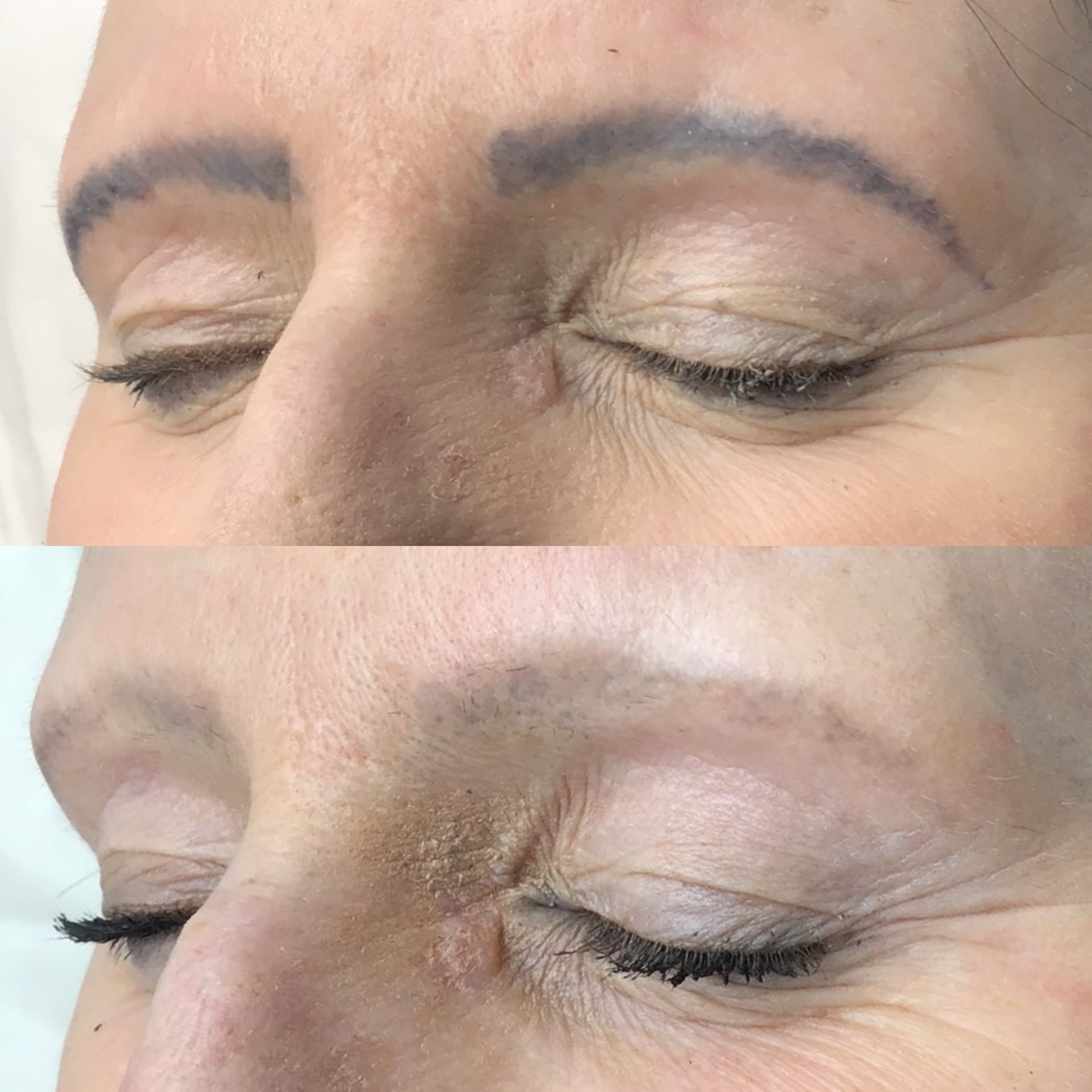 Tattoo Laser Removal Tattoo Laser Removal
