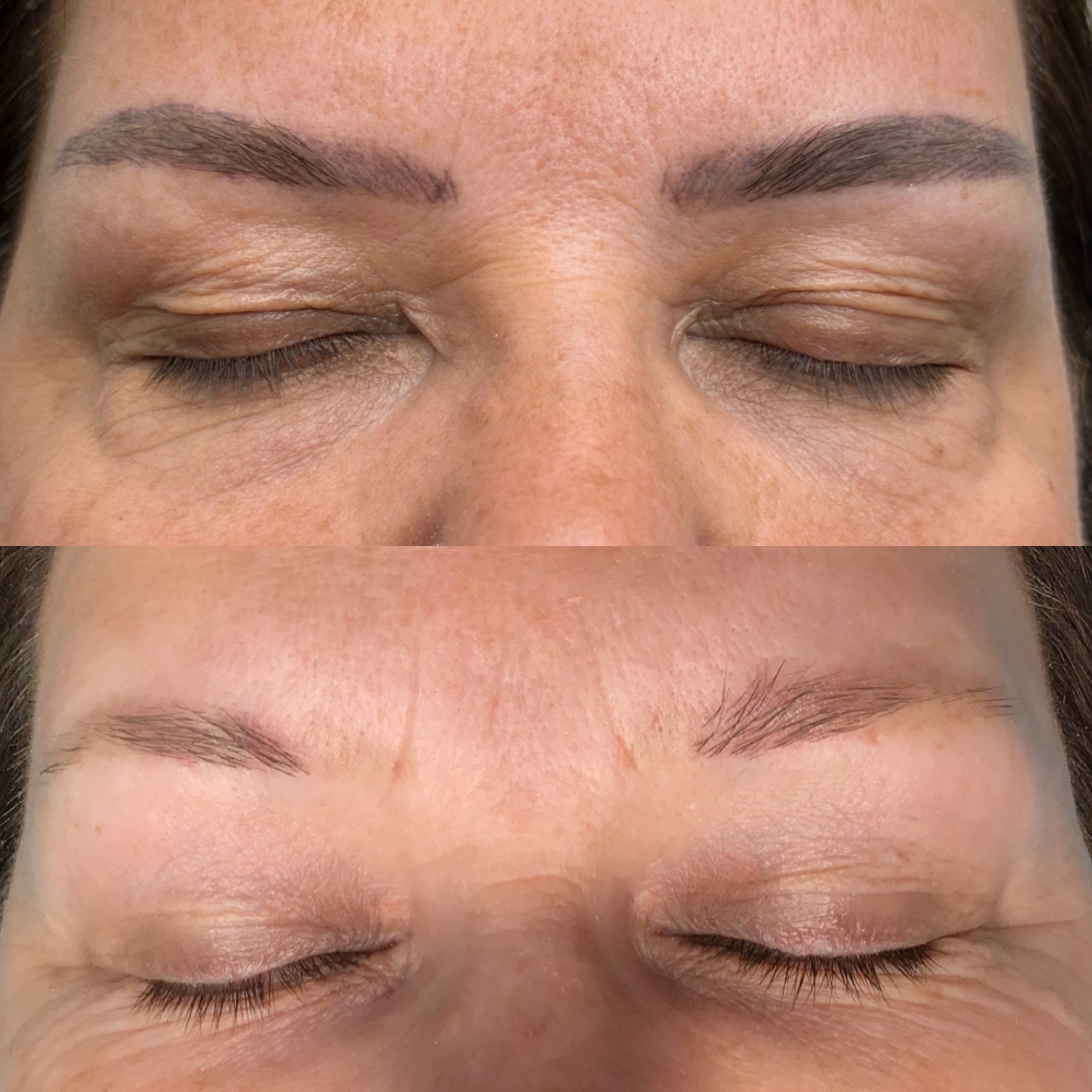 Tattoo Laser Removal Tattoo Laser Removal