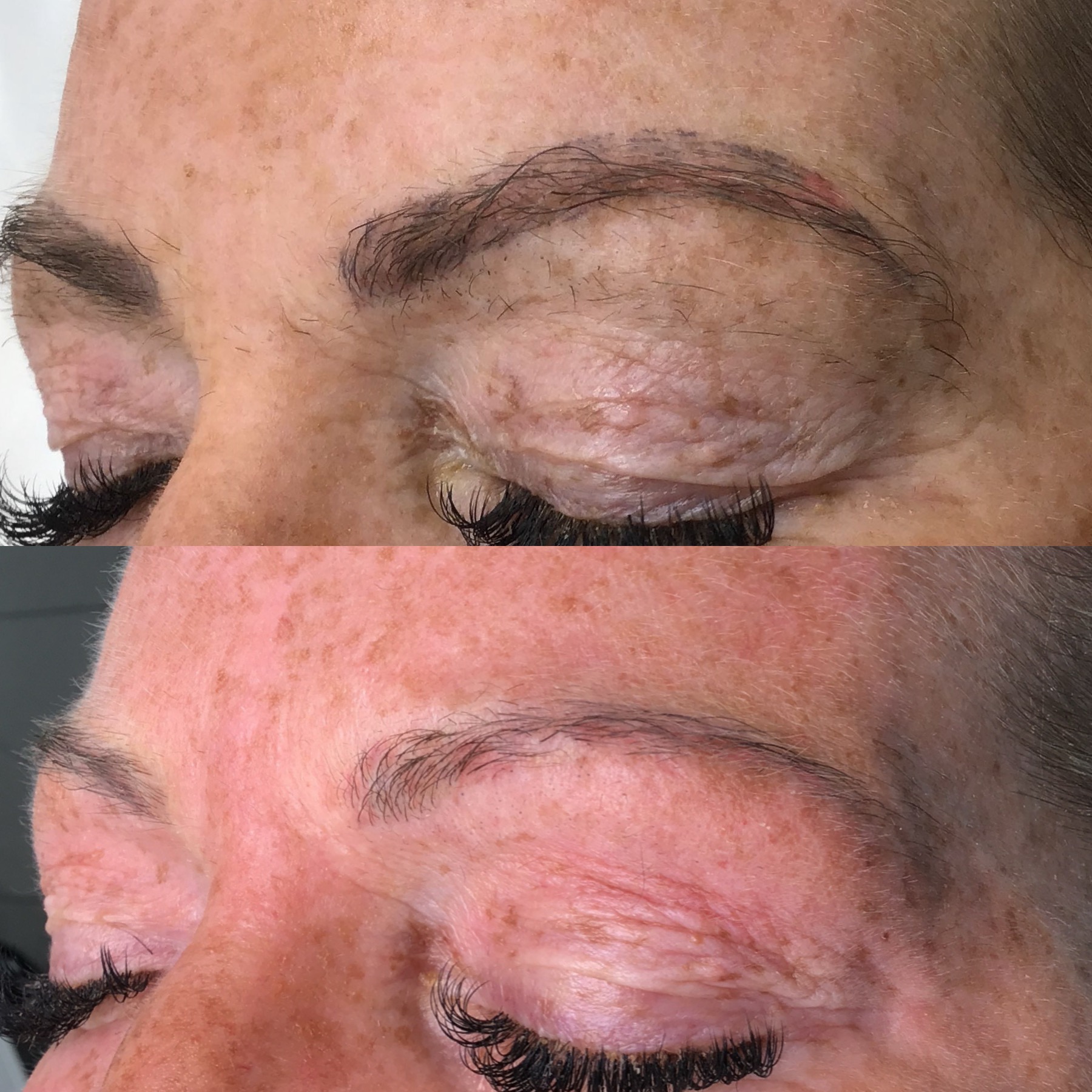 Tattoo Laser Removal Tattoo Laser Removal