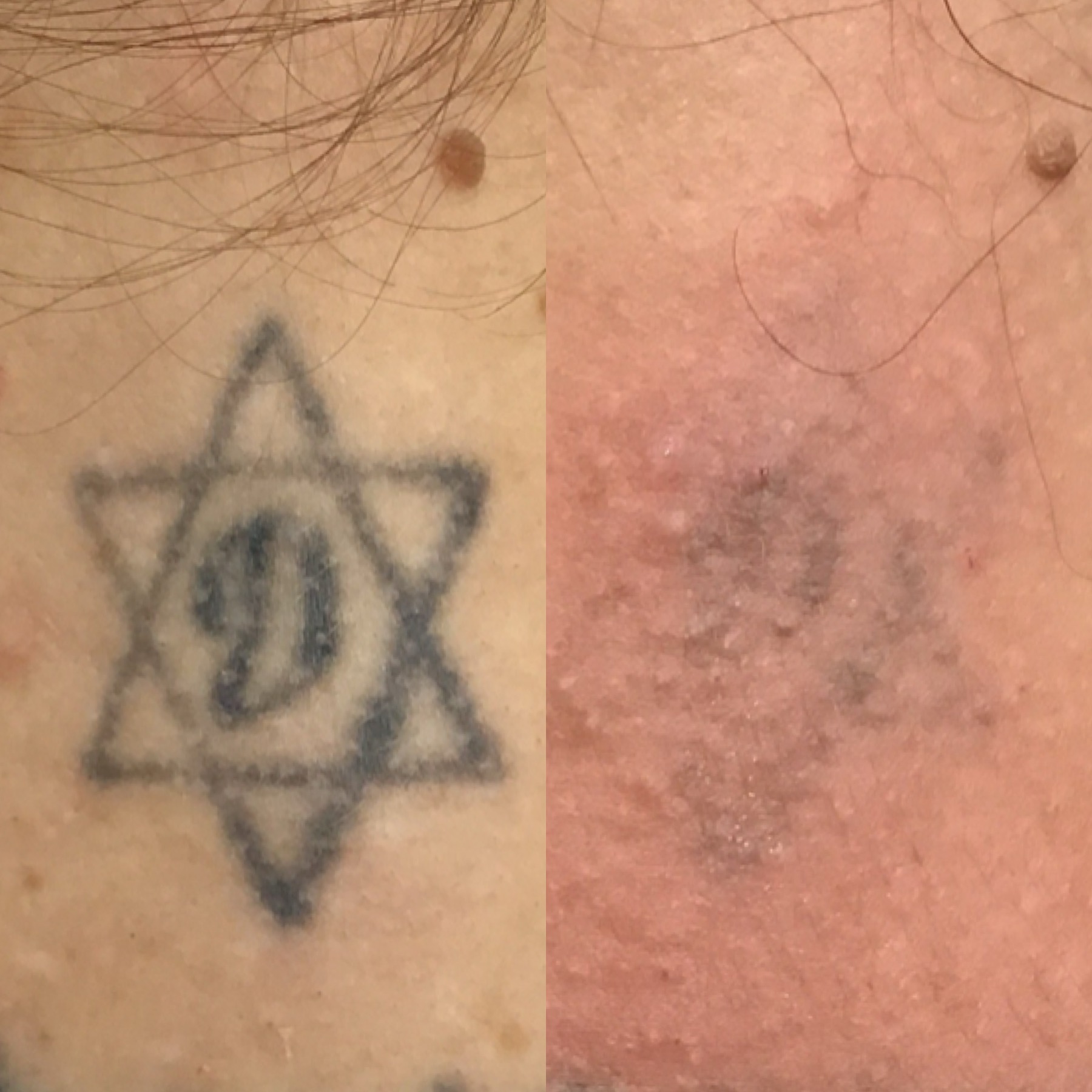 Tattoo Laser Removal